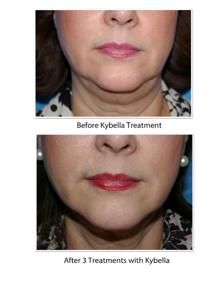Results Of Kybella Treatment Dermatology Consultants