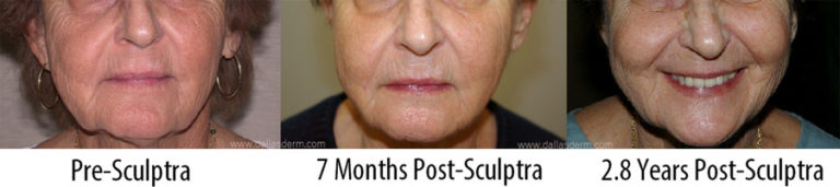Sculptra provided service by Drs. Maris and Euwer